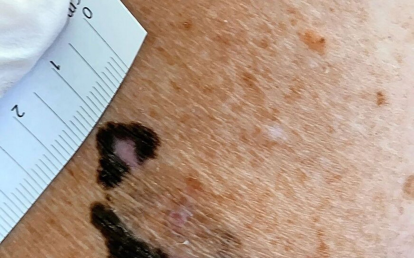 Schwarzer Hautkrebs: ein Melanom am Oberarm.