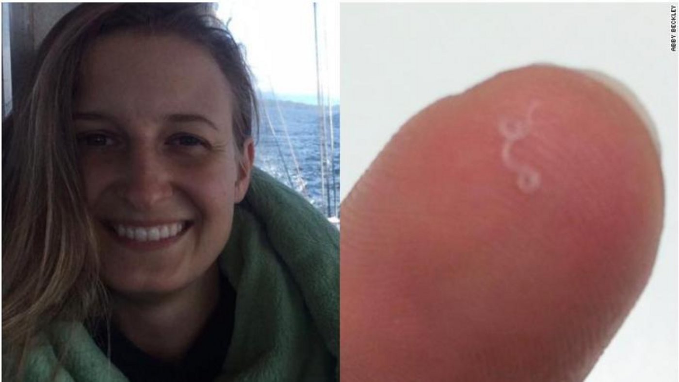 Abby Beckley staunte nicht schlecht als sich etwas in ihrem Auge bewegte.  (Bild Abby Beckley)