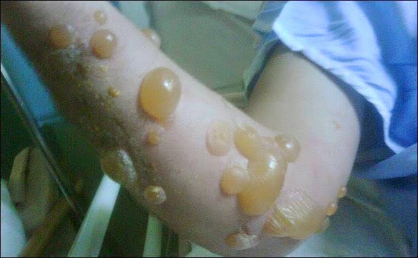 Auch der Arm des Kindes ist voller Blasen (Bild Impossible Carp)