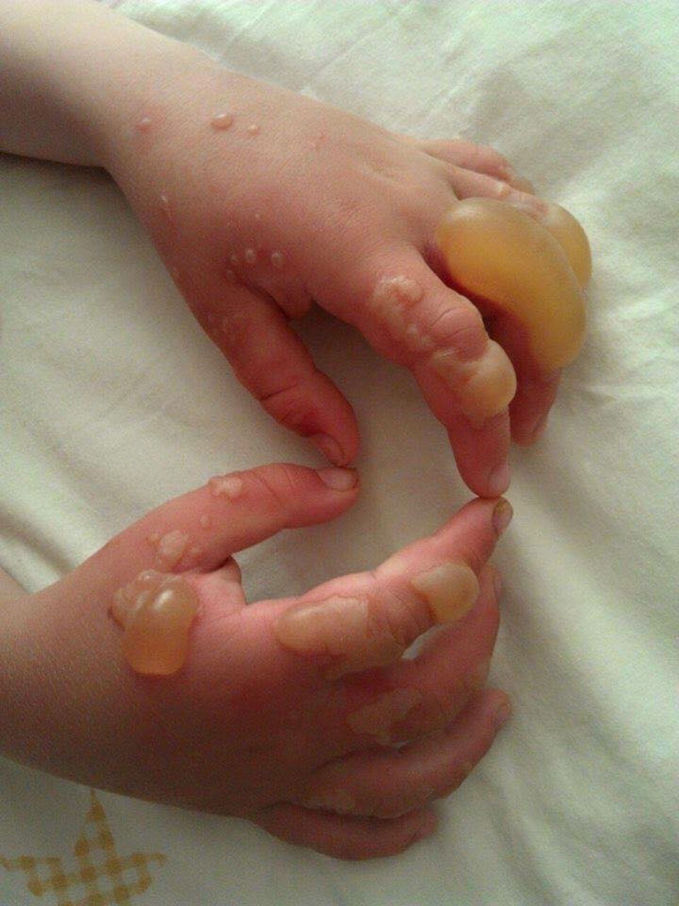 Dieses Kind kam mit der Pflanze in Berührung und musste ins Spital (Bild Impossible Carp)