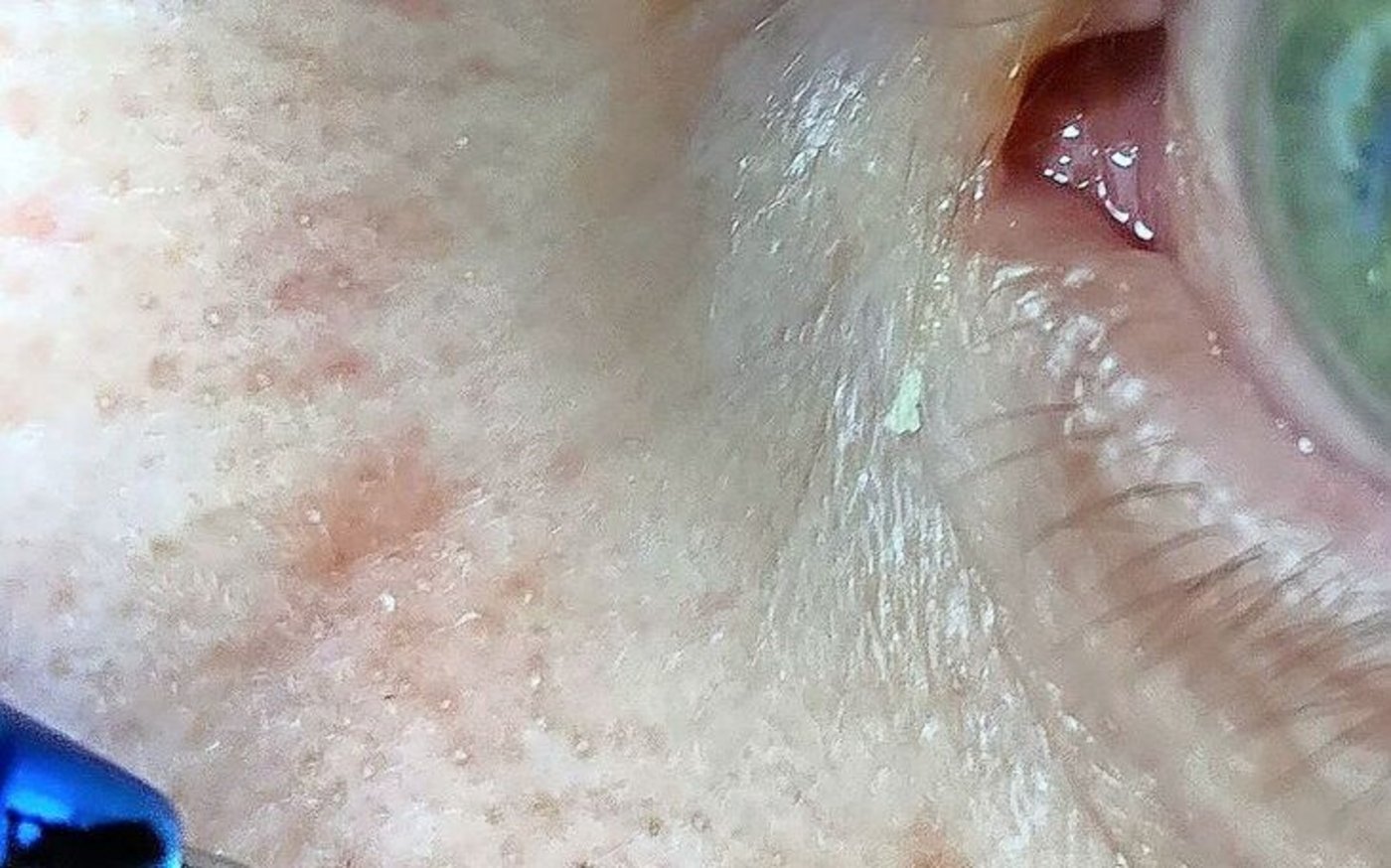 Weisser Hautkrebs: ein Basalzellkarzinom an der Nase.