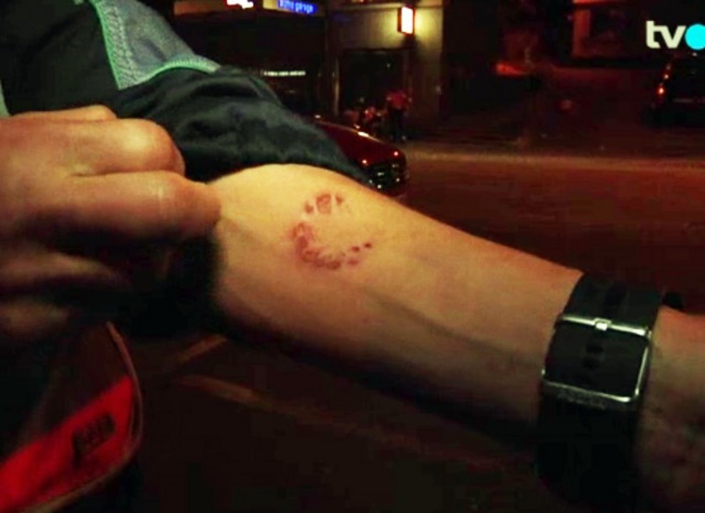 Der verletzte Polizist zeigte seinen Bisswunde in einem TV-Beitrag. (Bild Screenshot TVO/via FM1Today)