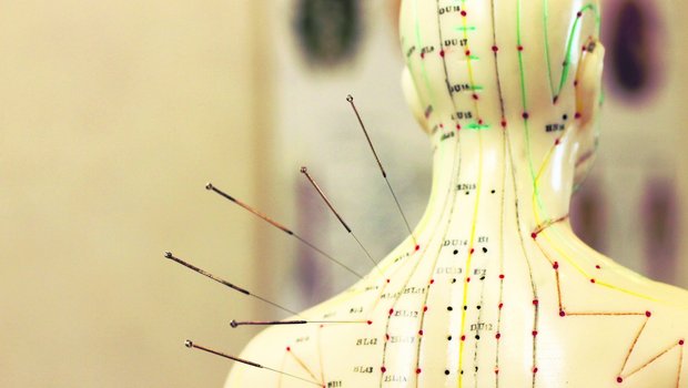 Ambulante Zusatzversicherungen decken auch Akupunkturbehandlungen ab. Der gezielte Einsatz von Nadeln hilft Patienten u. a. bei Kopfschmerzen und Rheuma. (Bild iStock)