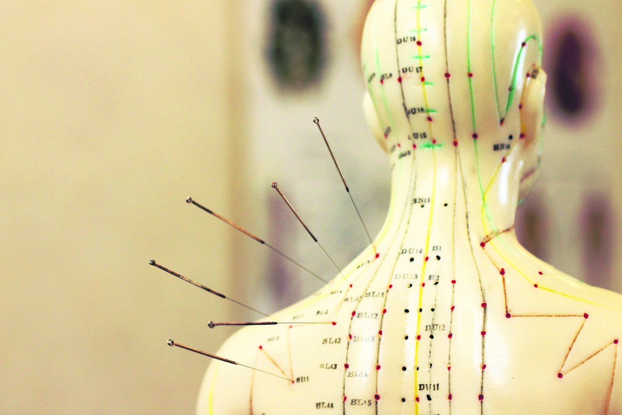 Ambulante Zusatzversicherungen decken auch Akupunkturbehandlungen ab. Der gezielte Einsatz von Nadeln hilft Patienten u. a. bei Kopfschmerzen und Rheuma. (Bild iStock)