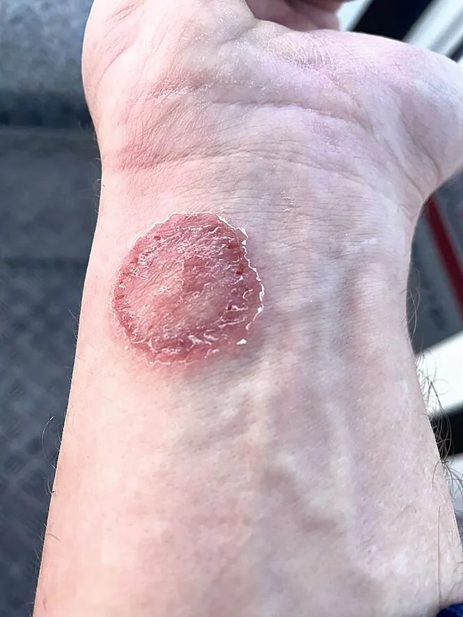 Am Handgelenk einer Person ist eine kreisrunde, rote Hautveränderung zu sehen.