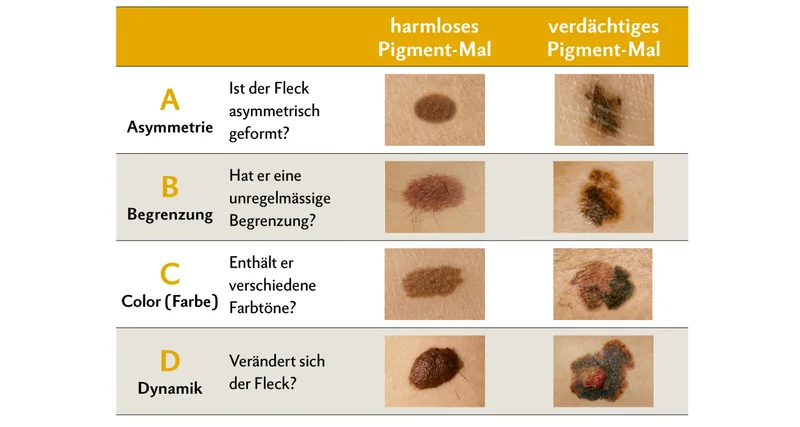 Wie erkennt man ein Melanom? Pigment-Male, die sich verändern, können gefährlich sein. Deshalb sollten sie so rasch als möglich von einem Dermatologen untersucht werden. Quelle: Dermatologie et vénéréologie, Hôpitaux Universitaires de Genève