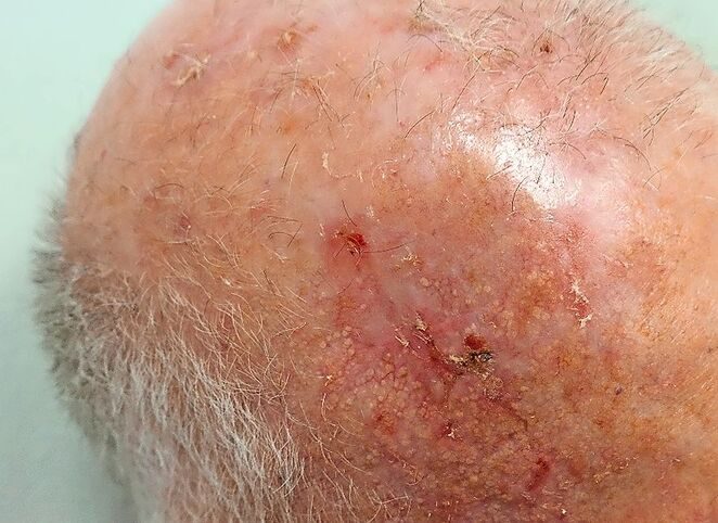 Krebsvorstufe: aktinische Keratosen auf einer Glatze.