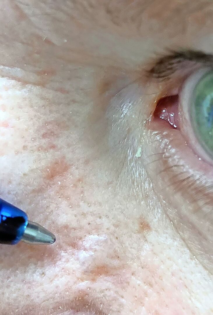 Weisser Hautkrebs: ein Basalzellkarzinom an der Nase.