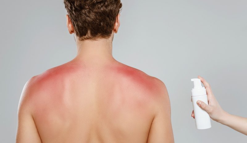 Schon eine kurze Sonneneinstrahlung kann zu Sonnenbrand führen. Landwirte gehören zur Risikogruppe für Hautkrebs. Bild: Adobe Stock